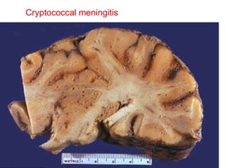 Cryptococcal meningitis 