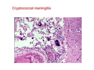 Cryptococcal meningitis 