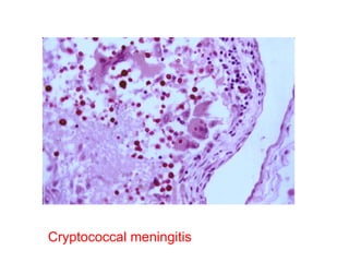 Cryptococcal meningitis 
