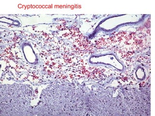 Cryptococcal meningitis 