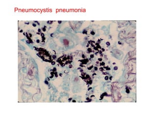 Pneumocystis  pneumonia 