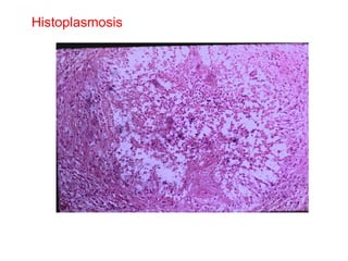 Histoplasmosis 