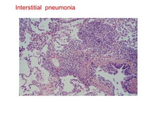 Interstitial  pneumonia 
