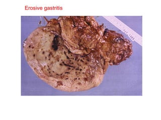 Erosive gastritis 