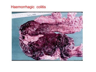 Haemorrhagic  colitis 
