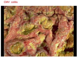 CMV  colitis 