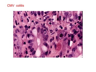 CMV  colitis 