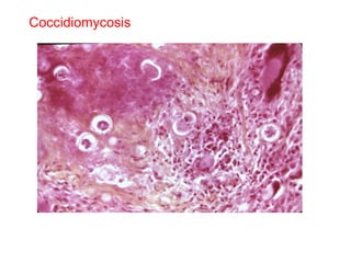 Coccidiomycosis 