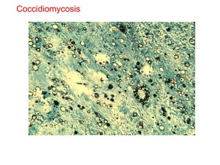 Coccidiomycosis 