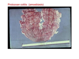 Protozoan colitis  (amoebiasis) 