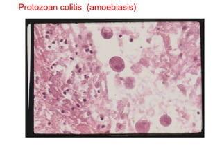 Protozoan colitis  (amoebiasis) 