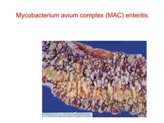 Mycobacterium avium complex (MAC) enteritis 