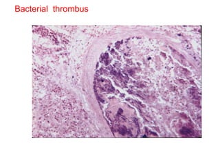 Bacterial  thrombus 