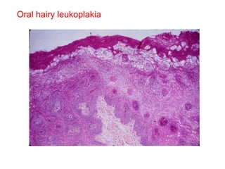 Oral hairy leukoplakia 