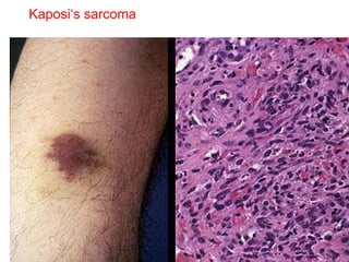 Kaposi‘s sarcoma 