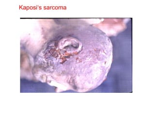 Kaposi‘s sarcoma 