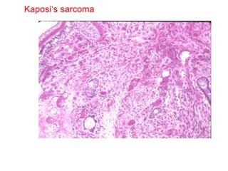 Kaposi‘s sarcoma 