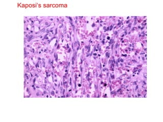 Kaposi‘s sarcoma 