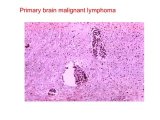 Primary brain malignant lymphoma 