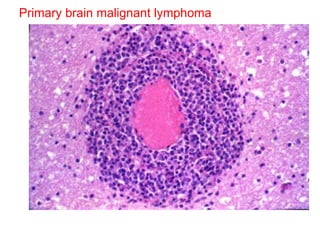 Primary brain malignant lymphoma 