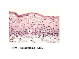 HPV – koilocytosis - LSIL 
