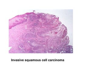 Invasive squamous cell carcinoma 