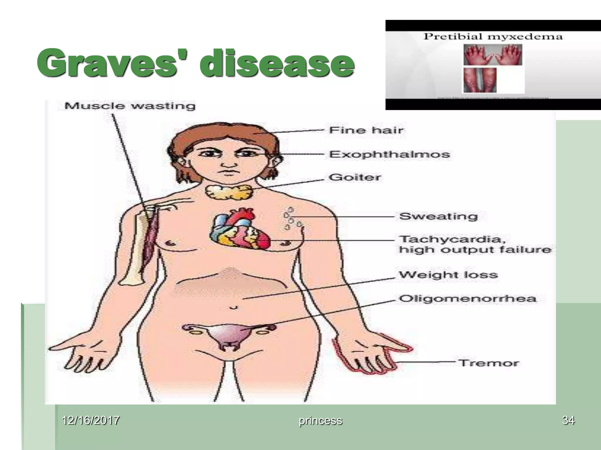 Graves' disease
The classic finding of exophthalmos and lid retraction in
Graves' disease
Specialty Endocrinology
Symptoms Enlarged thyroid, irritability,
muscle weakness, sleeping
problems, fast heartbeat,
poor tolerance of heat
[1]
Complications Graves' ophthalmopathy
[1]
Causes Unknown
[2]
Risk factors Family history,
other autoimmune diseases
[1]
Diagnostic method Blood
tests, radioiodine uptake
[1][3]
Treatment Radioiodine therapy,
medications, thyroid
surgery
[1]
Frequency 0.5% (males), 3%
(females)
[4]
12/16/2017 princess 34
 