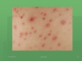 Immunologic Disorders Ppt Pptx