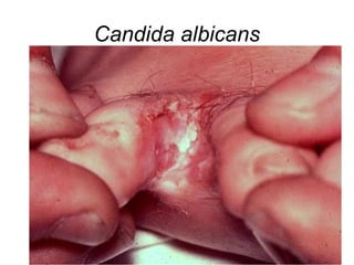 Candida albicans

 