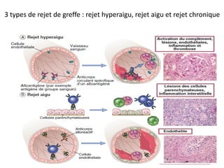3 types de rejet de greffe : rejet hyperaigu, rejet aigu et rejet chronique
 