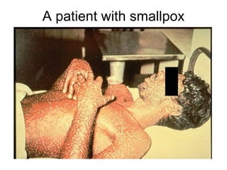 A patient with smallpox 