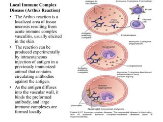 Local Immune Complex
Disease (Arthus Reaction)
• The Arthus reaction is a
localized area of tissue
necrosis resulting from
acute immune complex
vasculitis, usually elicited
in the skin.
• The reaction can be
produced experimentally
by intracutaneous
injection of antigen in a
previously immunized
animal that contains
circulating antibodies
against the antigen.
• As the antigen diffuses
into the vascular wall, it
binds the preformed
antibody, and large
immune complexes are
formed locally
 