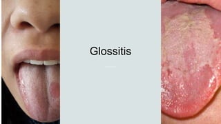 Glossitis
 
