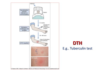 DTH
E.g.. Tuberculin test
 