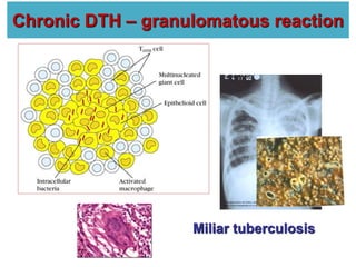 Chronic DTH – granulomatous reaction
Miliar tuberculosis
 