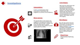 Investigations
Chest X-ray:
Pneumonitis of both lung
fields
Skin Biopsy:
Skin with deep seated histiocytic
infiltrate within the subcutaneous
tissue. CD1a and S100 are
negative excluding a Langerhans
cell infiltrate; Chloroacetate
esterase stain is positive in some
of the immature myeloid cells.
Stains for AFB and fungi are
negative.
Liver biopsy:
Mild portal tract inflammation with
eosinophils, extramedullary
haemopoeisis and focal lobular
inflammation; Mild macrovesicular
steatosis; Liver biopsy result is in
keeping with mild portal tract
chronic inflammation with one non-
necrotising granuloma on deeper
sections, Ziehl Nielsen stains for
AFB negative.
Bone marrow:
The aspirate failed, but the trephine was
suggestive of mycobacterial infection with
secondary marrow fibrosis. In addition, one
of the TB cultures were Zn positive,
however the final culture yielded no growth
(could be MOTTS or MTB).
interpretation:
T and B cell lymphopaenia noted
Preservation of natural killer cells
Suggestive of a primary immune deficiency
 