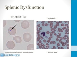 Splenic Dysfunction
Paulo Henrique Orlandi Mourao /Mikael Häggström Dr Graham Beards
Howell-Jolly Bodies
Target Cells
 