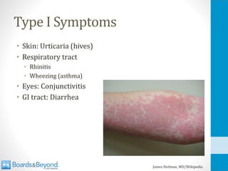 Type I Symptoms
• Skin: Urticaria (hives)
• Respiratory tract
• Rhinitis
• Wheezing (asthma)
• Eyes: Conjunctivitis
• GI tract: Diarrhea
James Heilman, MD/Wikipedia
 
