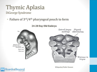 Thymic Aplasia
DiGeorgeSyndrome
• Failure of 3rd/4th pharyngeal pouch to form
Wikipedia/Public Domain
24-28 Day Old Embryo
 