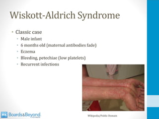Wiskott-Aldrich Syndrome
• Classic case
• Male infant
• 6 months old (maternal antibodies fade)
• Eczema
• Bleeding, petechiae (low platelets)
• Recurrent infections
Wikipedia/Public Domain
 