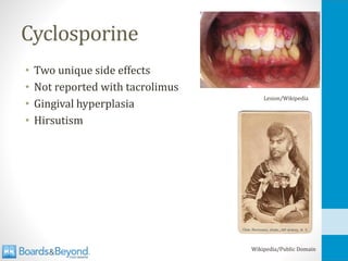 Cyclosporine
• Two unique side effects
• Not reported with tacrolimus
• Gingival hyperplasia
• Hirsutism
Lesion/Wikipedia
Wikipedia/Public Domain
 
