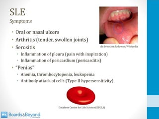 SLE
Symptoms
• Oral or nasal ulcers
• Arthritis (tender, swollen joints)
• Serositis
• Inflammation of pleura (pain with inspiration)
• Inflammation of pericardium (pericarditis)
• “Penias”
• Anemia, thrombocytopenia, leukopenia
• Antibody attack of cells (Type II hypersensitivity)
de:Benutzer:Padawan/Wikipedia
Databese Center for Life Science (DBCLS)
 