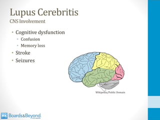 Lupus Cerebritis
CNSInvolvement
• Cognitive dysfunction
• Confusion
• Memory loss
• Stroke
• Seizures
Wikipedia/Public Domain
 