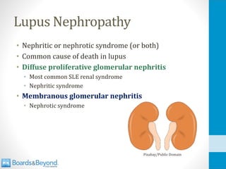 Lupus Nephropathy
• Nephritic or nephrotic syndrome (or both)
• Common cause of death in lupus
• Diffuse proliferative glomerular nephritis
• Most common SLE renal syndrome
• Nephritic syndrome
• Membranous glomerular nephritis
• Nephrotic syndrome
Pixabay/Public Domain
 