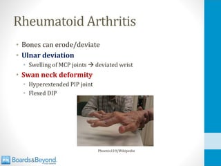Rheumatoid Arthritis
• Bones can erode/deviate
• Ulnar deviation
• Swelling of MCP joints → deviated wrist
• Swan neck deformity
• Hyperextended PIP joint
• Flexed DIP
Phoenix119/Wikipedia
 