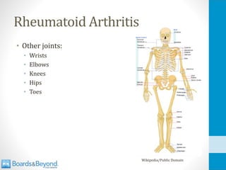 Rheumatoid Arthritis
• Other joints:
• Wrists
• Elbows
• Knees
• Hips
• Toes
Wikipedia/Public Domain
 
