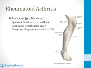 Rheumatoid Arthritis
• Baker's cyst (popliteal cyst)
• Synovium-lined sac at back of knee
• Continuous with the joint space
• If ruptures → symptoms similar to DVT
Wikipedia/Public Domain
 