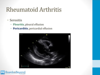 Rheumatoid Arthritis
• Serositis
• Pleuritis, pleural effusion
• Pericarditis, pericardial effusion
 