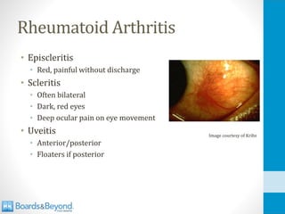 Rheumatoid Arthritis
• Episcleritis
• Red, painful without discharge
• Scleritis
• Often bilateral
• Dark, red eyes
• Deep ocular pain on eye movement
• Uveitis
• Anterior/posterior
• Floaters if posterior
Image courtesy of Kribz
 