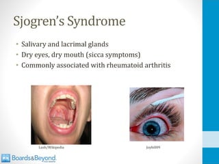 Sjogren’s Syndrome
• Salivary and lacrimal glands
• Dry eyes, dry mouth (sicca symptoms)
• Commonly associated with rheumatoid arthritis
Lusb/Wikipedia Joyhill09
 